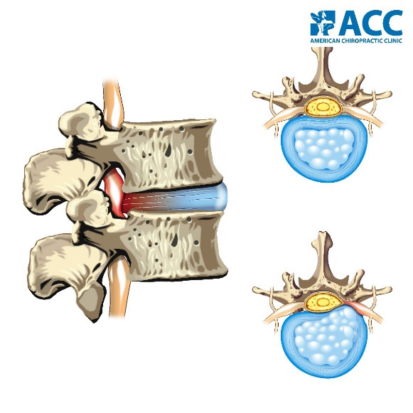 đĩa đệm cột sống đĩa đệm cột sống