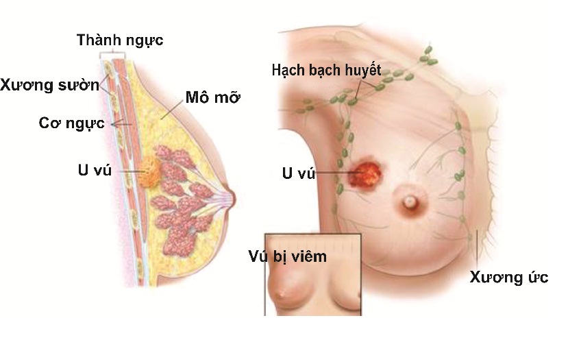 khối u vú