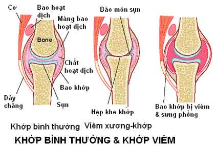 viêm khớp